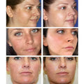 Whitening Freckles Cream Remove Melasma Dark Spots Lighten Melanin Melasma Remover Moisturizing Brighten Face Skin Care TRSTAY