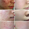 Salicylic Acid Acne Treatment Face Cream Repair Pimple Spots Deep Cleaning Pore Anti-acne Scar Oil Control Moisturizer Skin Care